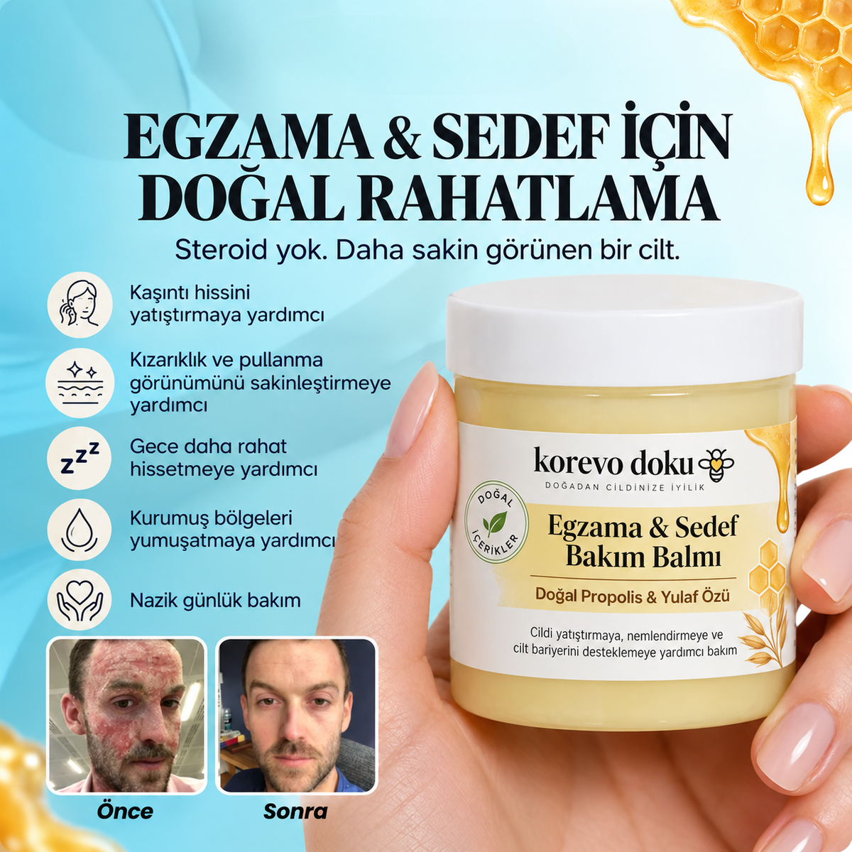 Korevo Doku Egzama - Sedef Bakım Balmı
